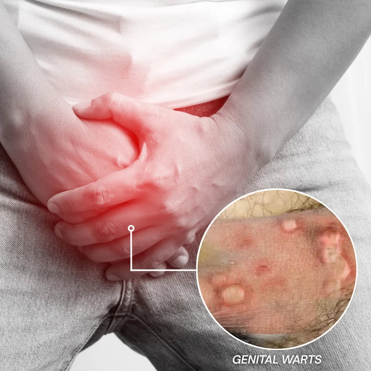 Alcuras® HPV Genital Warts Relief Cream