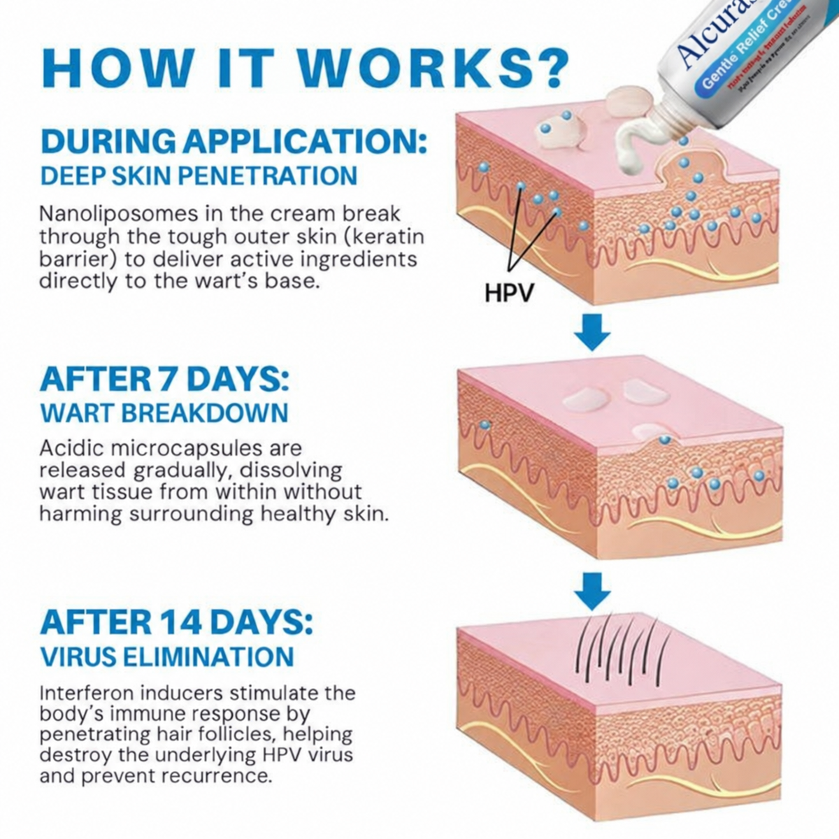 Alcuras® HPV Genital Warts Relief Cream