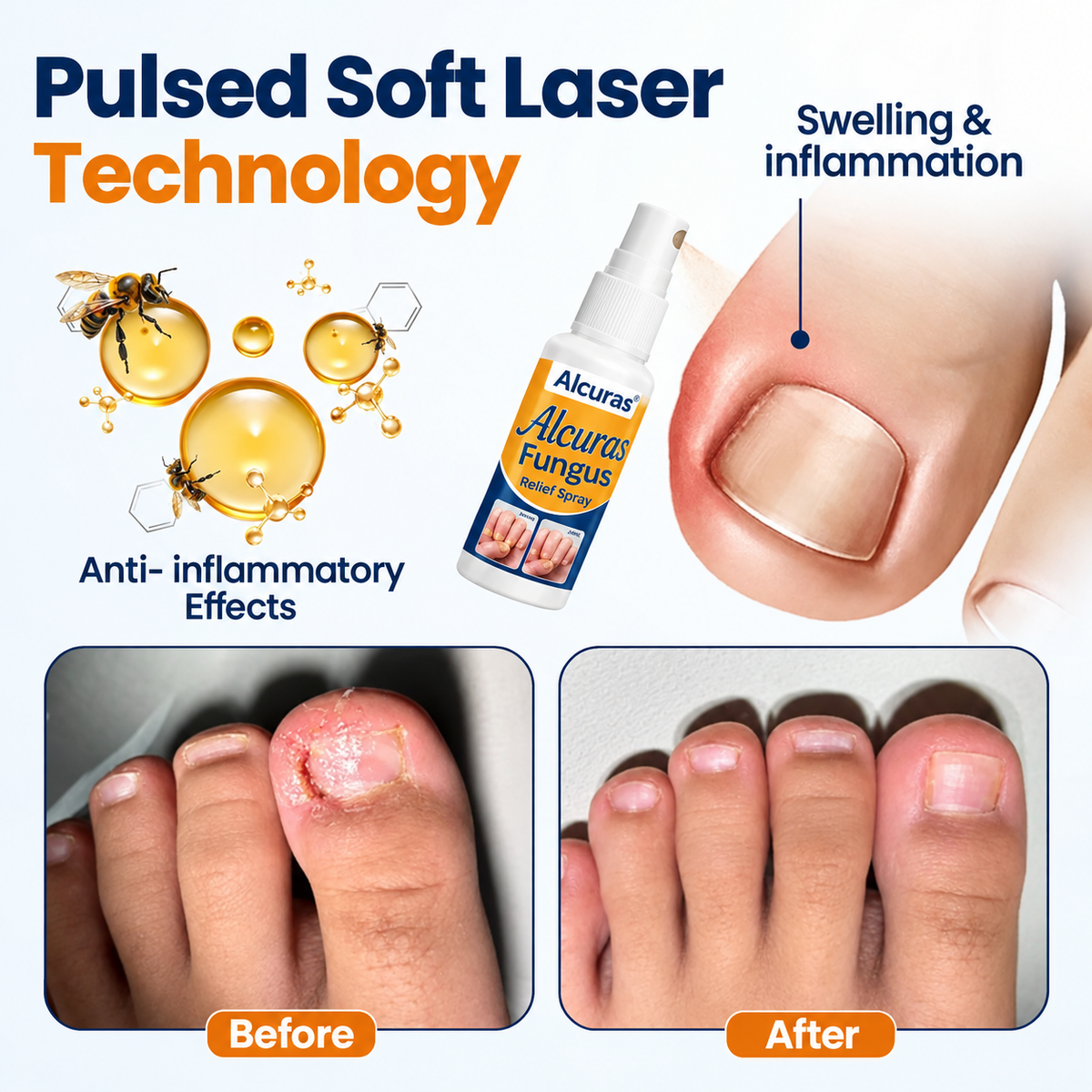 Alcuras® Nail fungus relief spray